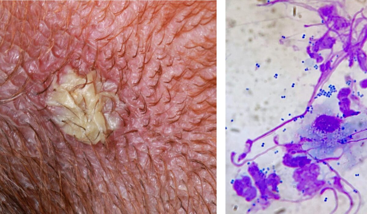 Bullous Impetigo: Flocculent Interfollicular Pustule & immediate Diagnostic Cytology