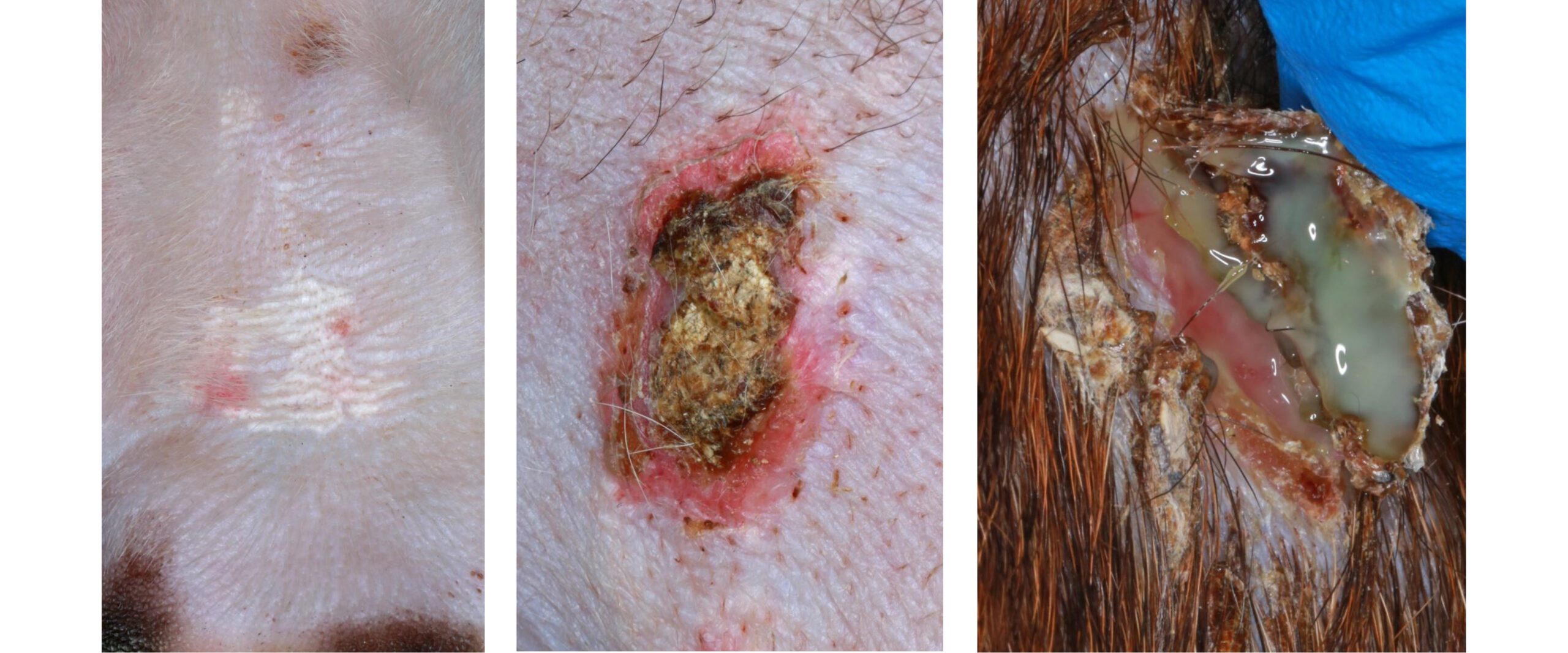 Calcinosis cutis, secondary to adrenal carcinoma: early & later stage plus secondary infection