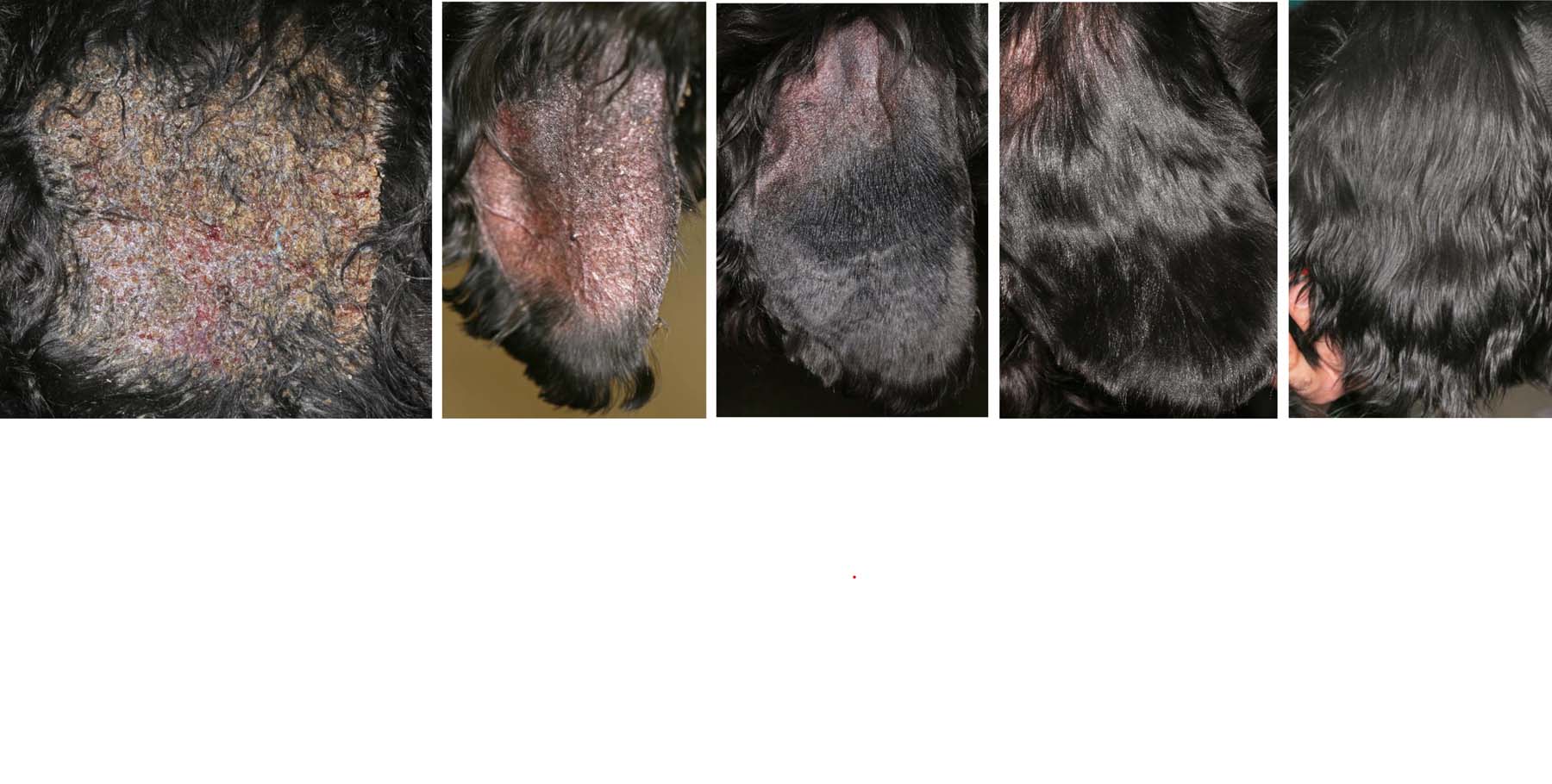 Canine Pemphigus Foliaceus: External Ear Flap on immediate Diagnosis, 2, 5, 10, 23 & 42 weeks post Pulse Treatment, Cocker Spaniel
