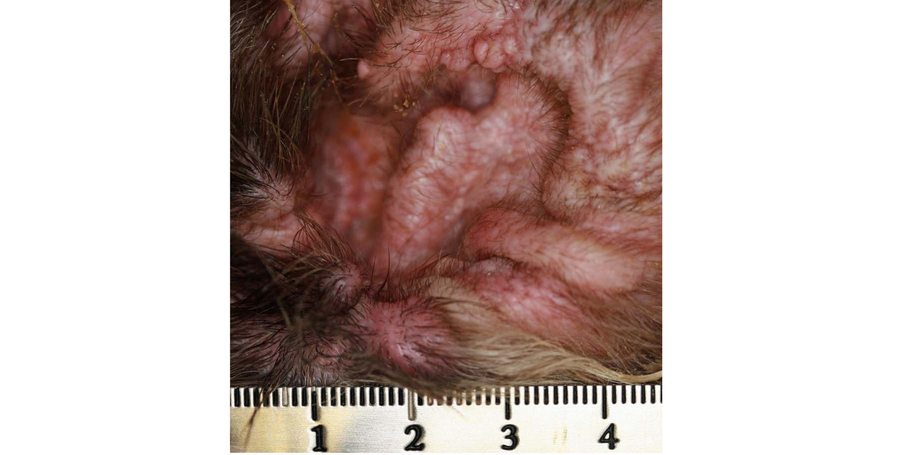Chronic Recurrent Otitis with Secondary Ceruminous Gland Hyperplasia