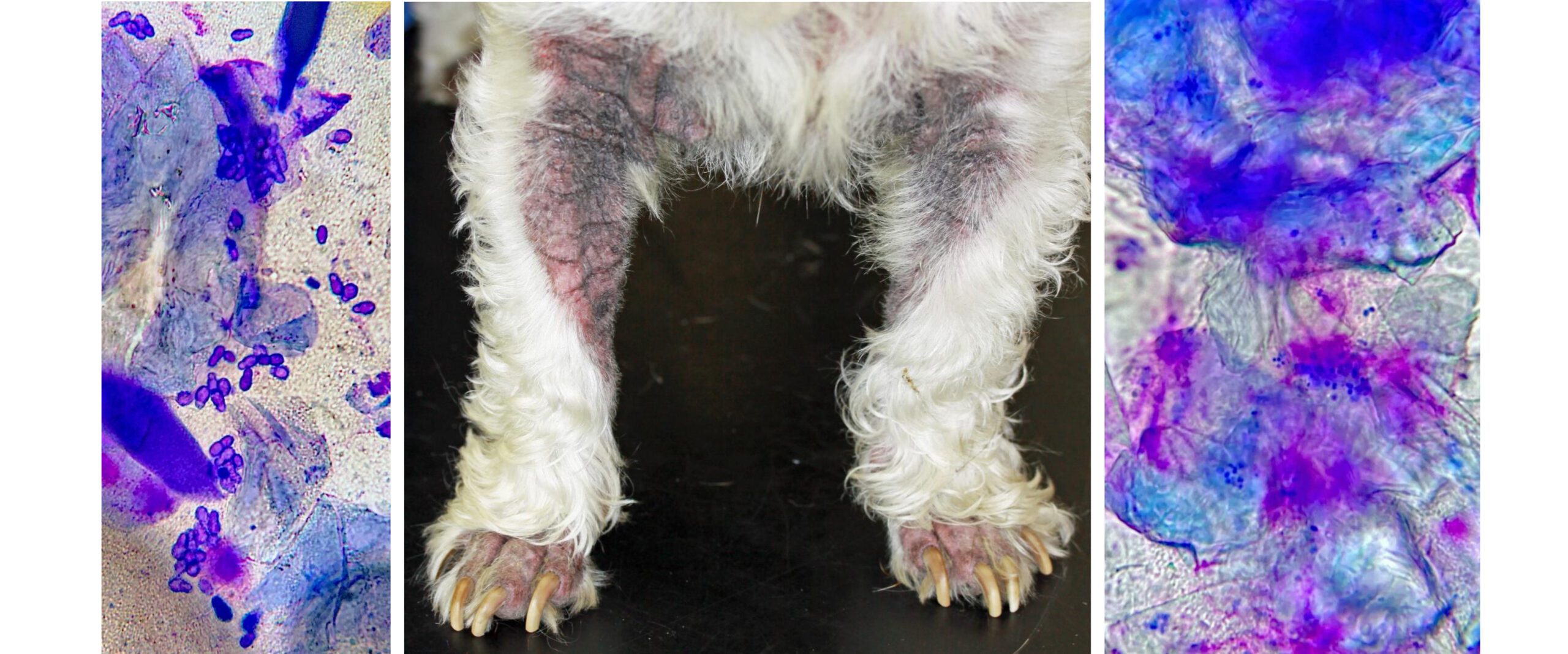 Chronic Atopic Dermatitis with Secondary Microbial Overgrowth: a simple, rapid Tape Strip allows Immediate Diagnosis & therefore Targetted Treatment