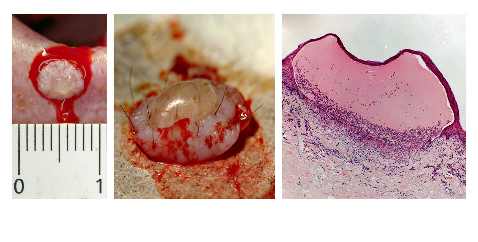 Very rare Epidermolysis Bullosa Acquisita: Vesicle During Biopsy, Intact Vesicle after Biopsy, Histopathology