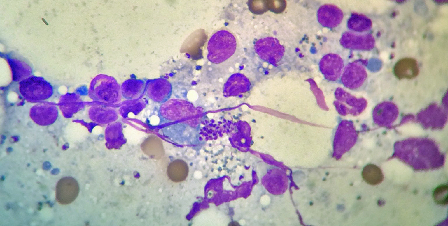 Leishmania Amastigotes, pouring out of a ruptured Macrophage, in-house Lymph Node Aspirate Cytology