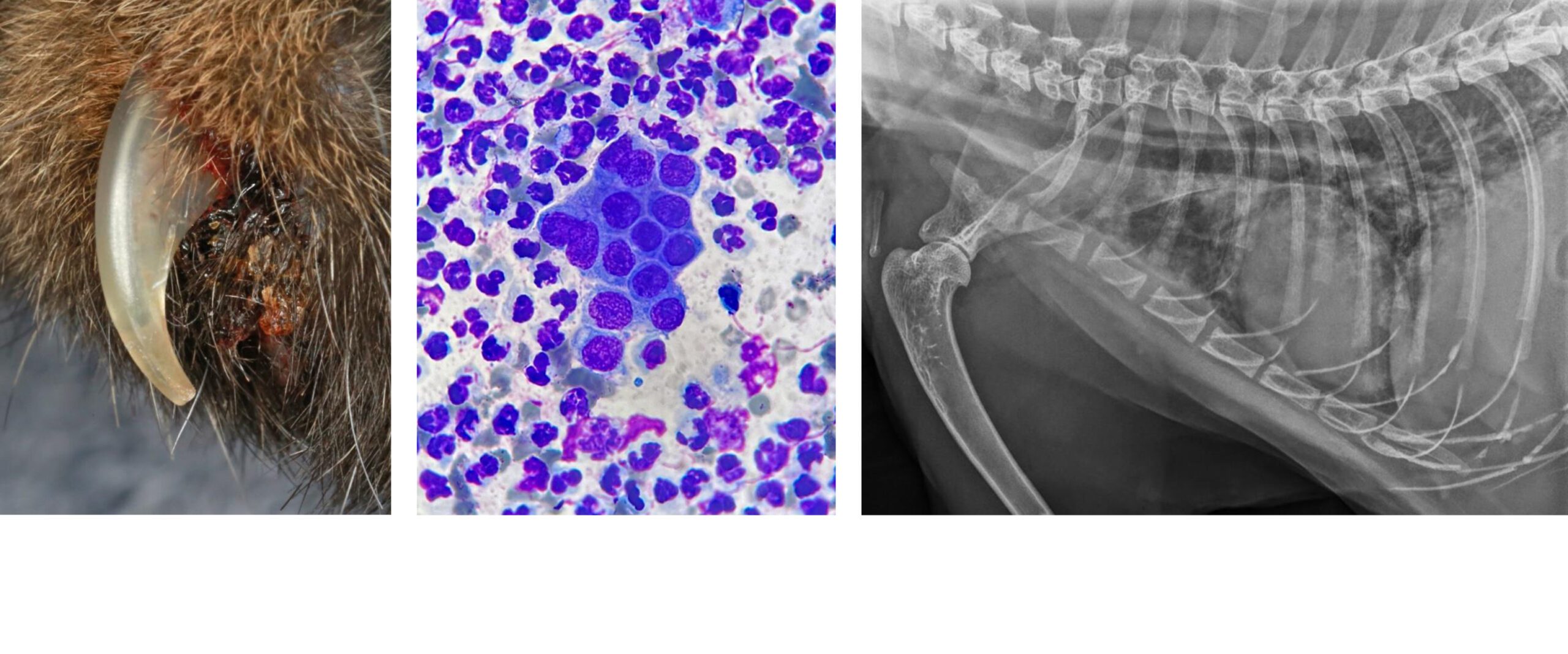 Rare Lung-Digit Syndrome: Chronic Claw Bed 'Infection': 1st Consultation Neoplastic cells within Pus on Simple Rapid Cytology; Neoplastic Infiltrates in Lungs on Reviewed Past Chest XRay