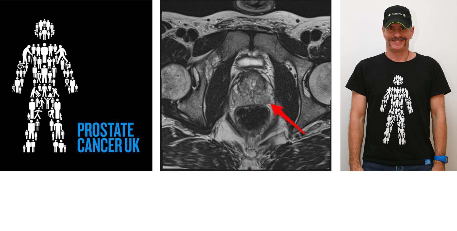 Prostate Cancer: my MRI scan & me, increasing awareness during Mo-vember
